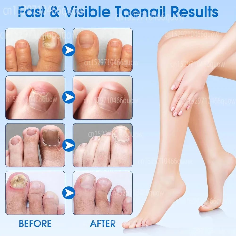 Toenail Fungus Treatment Stick - Nail Art Remove review and price